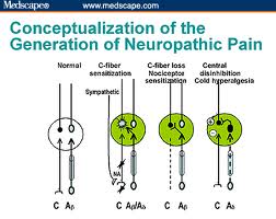 Generation of neuropathic pain chart