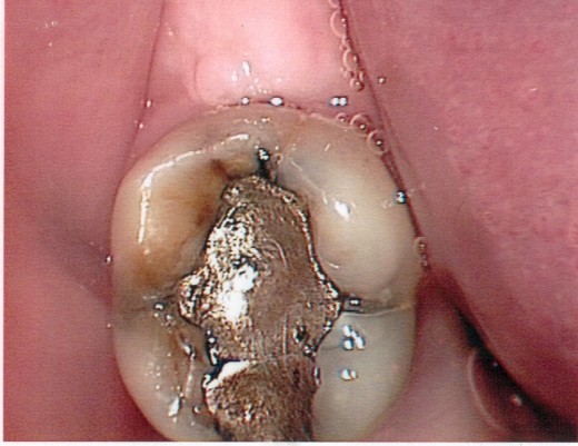 a broken tooth with old filling needing a crown