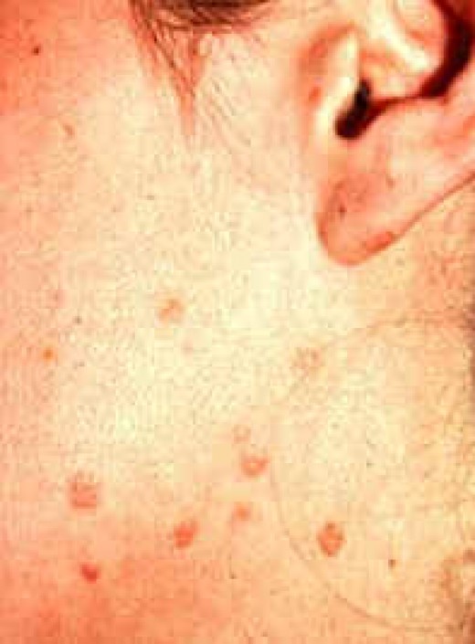 pictures-of-warts-warts-on-body-hubpages