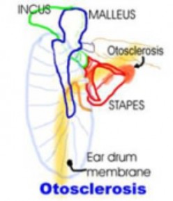Otosclerosis a hereditary cause of hearing loss