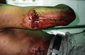 Glaser Wound
