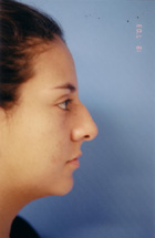 Before Rhinoplasty 