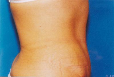 After Full Tummy Tuck