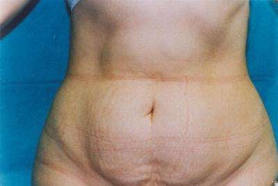 Different view of Tummy Tuck   Before