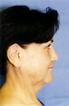 Before lower facelift