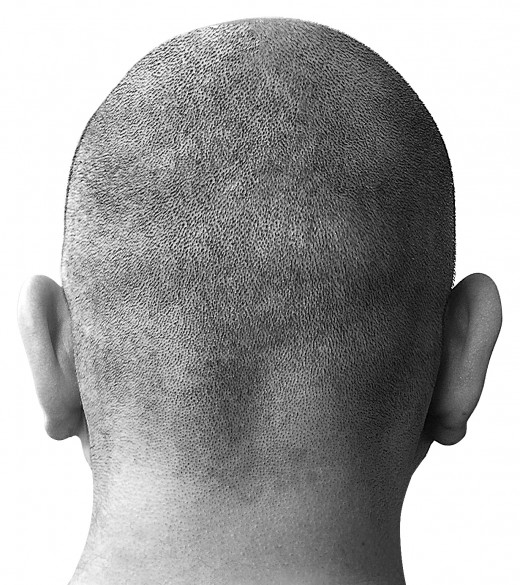 Some people prefer the no-hair look.  But for those that don't, there are several hair loss remedies out there.