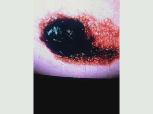 This is a picture of melanoma cancer of the skin. It's not a pretty sight.