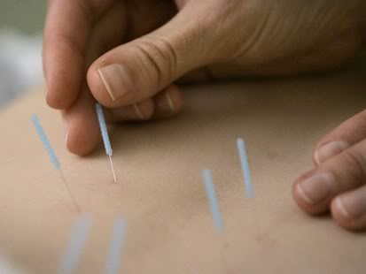 acupuncture courtesy of photobucket