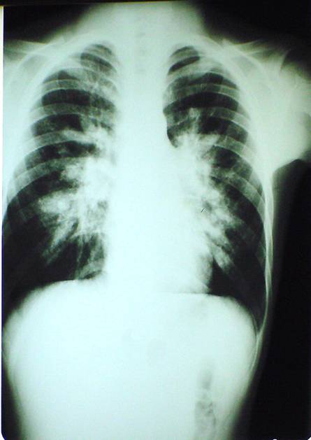 Patient is a 11 year old male presents with 4 months history of asthmatic symptoms. The usual asthmatic treatment brought no relief. Low dose steroids brought some improvement, but patients symptoms returned when the steroids were withdrawn.