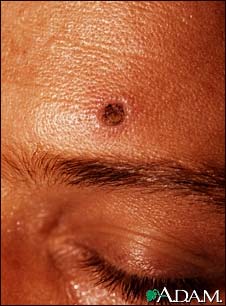 This is a skin lesion resulting from disseminated histoplasmosis. Histoplasmosis occurs most frequently as a lung infection, however it can infect the skin or become distributed (disseminated) to internal organs.