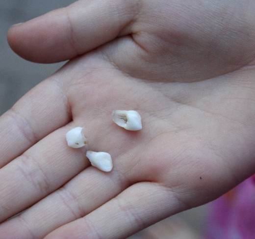 Baby Teeth Image Credit: Wikipedia