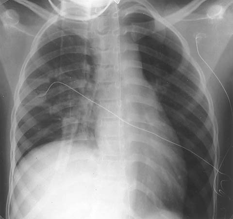 Chest radiograph 17 hours after extubation.