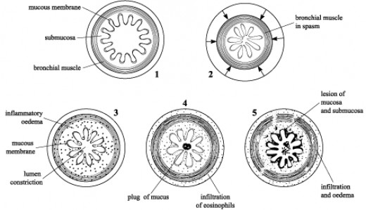 Ailments causing Bronchial obstruction- Especially, Chronic Obstructive ...