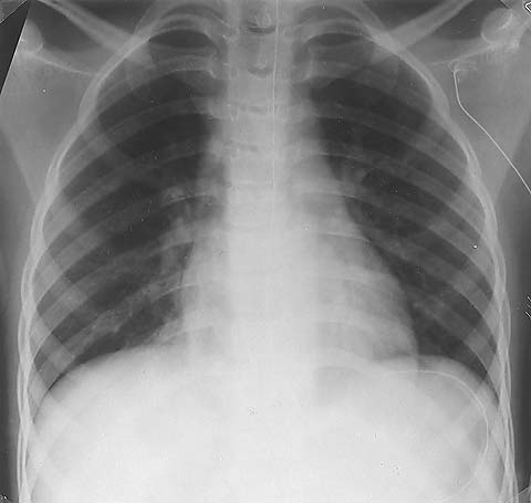 Chest radiograph 20 hours after extubation.