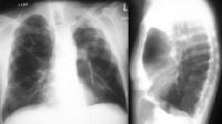 Chest radiograph shows hyperinflation, flattened diaphragms, increased retrosternal space, and hyperlucency of the lung parenchyma in emphysema.