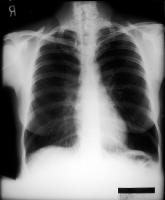 An emphysematous lung shows increased anteroposterior (AP) diameter, increased retrosternal airspace, and flattened diaphragms on posteroanterior (PA) film. 