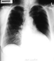 The differential diagnosis of unilateral hyperlucent lung includes pulmonary arterial hypoplasia and Swyer-James syndrome. The expiratory chest radiograph exhibits evidence of air trapping and is helpful in making the diagnosis. Swyer-James syndrome 