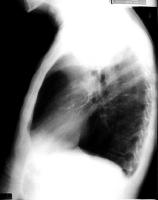 Lateral chest radiograph of Swyer-James syndrome may demonstrate some of the features of emphysema.