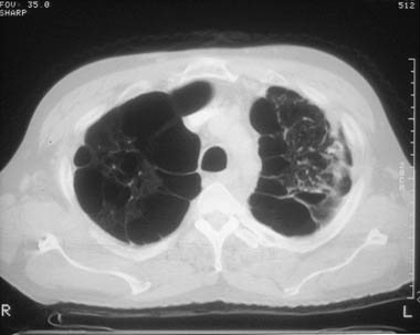 High-resolution CT (HRCT) scanning is more sensitive than standard chest radiography. HRCT scanning is highly specific for diagnosing emphysema and outlines bullae that are not always observed on radiographs. A CT scan is indicated when the patient i