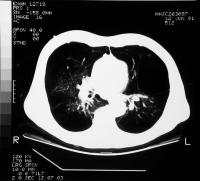 A CT scan showing severe emphysema and bullous disease.