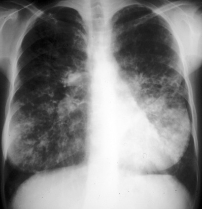 X-ray of patient with cystic fibrosis and respiratory failure. The signs are characteristic to main disease.