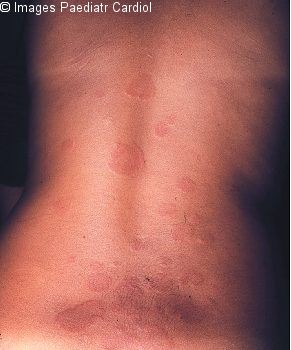 Erythema marginatum on the trunk, showing erythematous lesions with pale centers and rounded or serpiginous margins