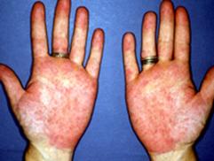 The palms become reddened (palmar erythema)  non-specific sign of JRA