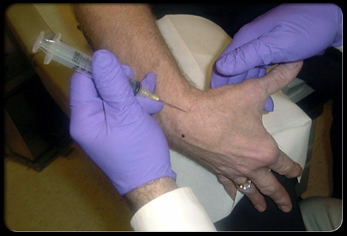 In arthrocentesis, a sterile needle and syringe are used to drain joint fluid out of the joint for study in the laboratory