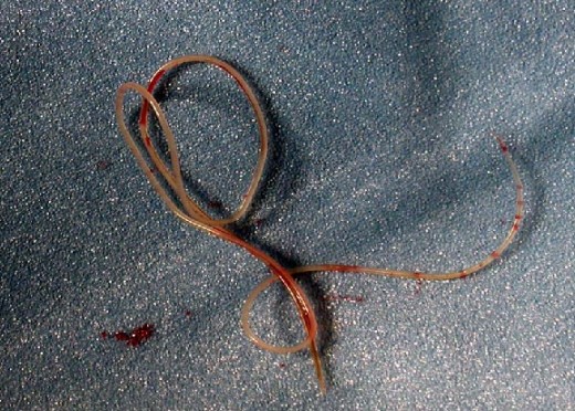 Heartworm after extraction