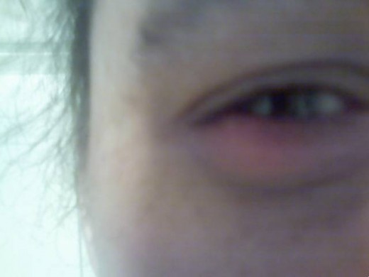 One of the styes