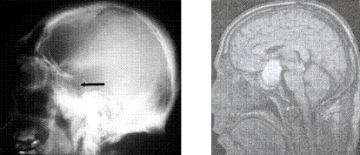 The sella turcica is enlarged  in at least 90 % of patients with acromegaly. (MRI , CT) Because of the slow progression of the disease, the sella is usually enlarged when the patient is first seen.