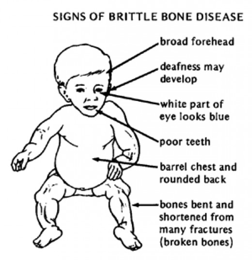 hypopituitarism-diagnostic-criteria-and-treatment-growth-hormone