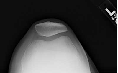 In the normal knee the patella is centered in the groove as seen on this x-ray of a bent knee looking down from above.