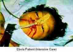 Victim of the Ebola virus in critical care