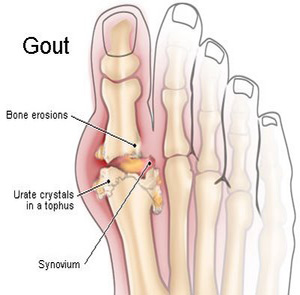 Gout