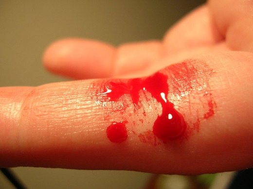 Loss of blood can be dangerous for anemic patients.