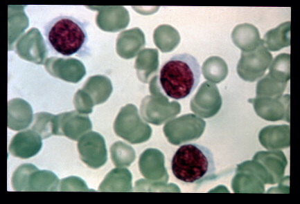 Hairy Cell Leukemia blood film