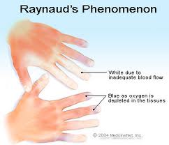 Example of Raynaud's Syndrome