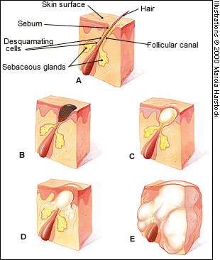 Figure showing stages of acne. (A) Normal follicle; (B) Open comedo (blackhead); (C) Closed comedo (whitehead); (D) Papule; (E) Pustule.