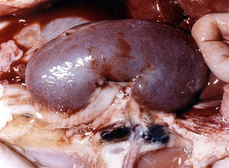 Perirenal edema