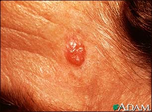 example of basal cell cancer located on the face