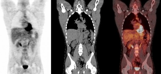PET/CT fusion: PET image on left, CT image in middle, fused image on right