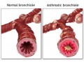 Natural Treatments For Asthma