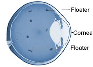 In this diagram floaters or specks can be seen behind the lens and cornea of the eyeball suspended within the vitreous humour