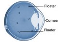 What Are Floaters  ?