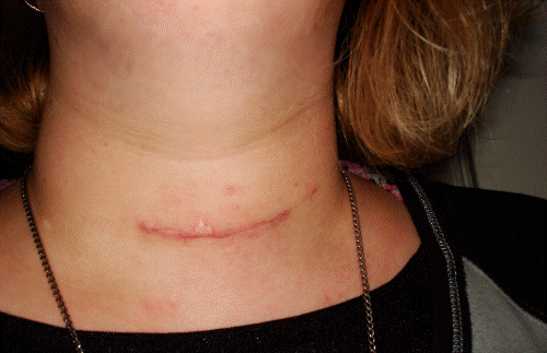 Scar after first surgery.