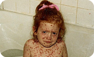 chickenpox rash
