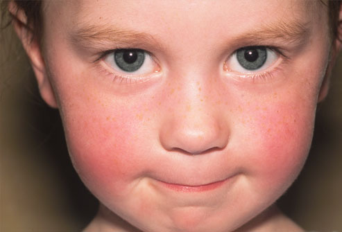 Child With "Slapped Cheek Disease" aka Fifth Disease