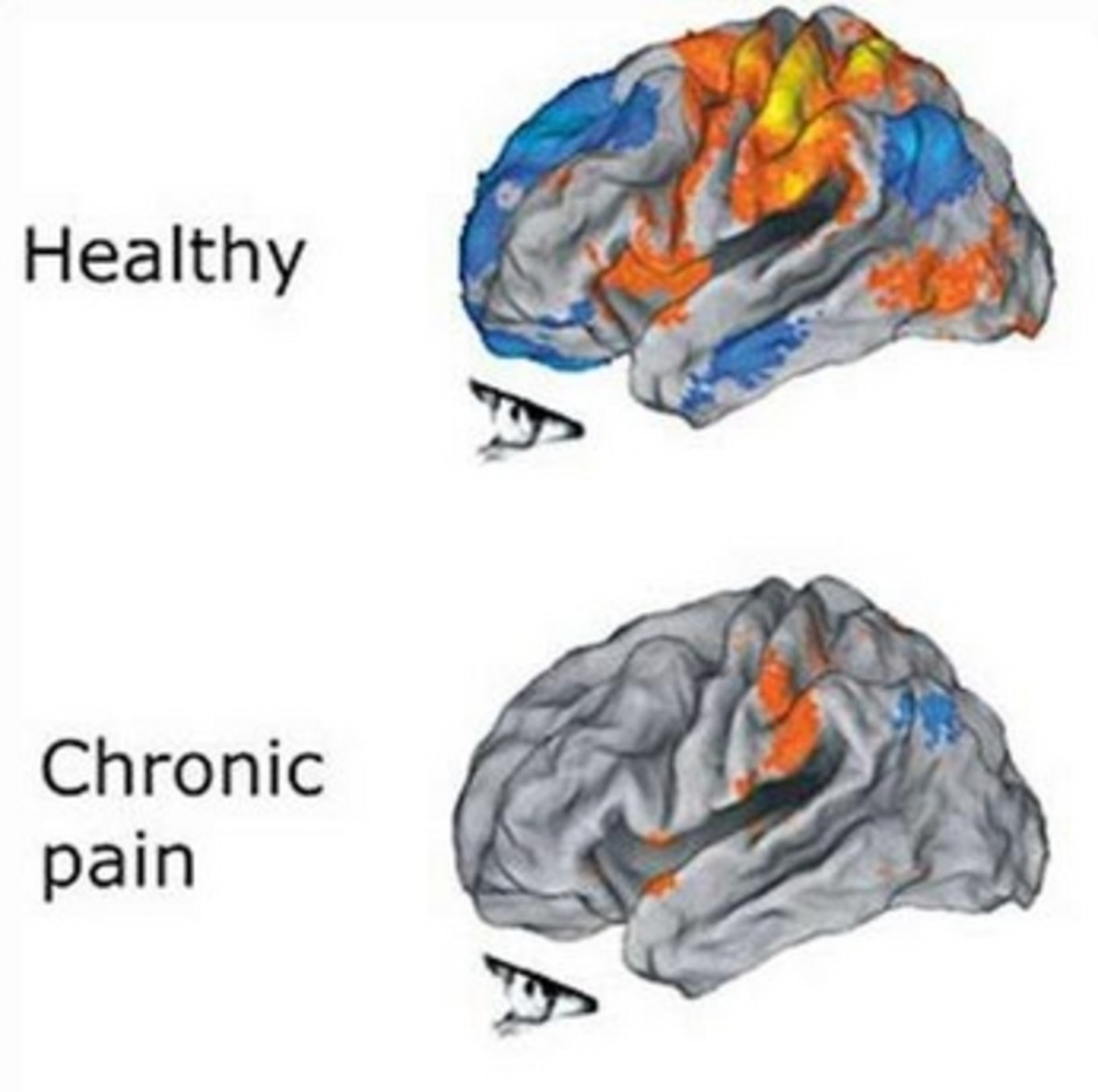 Brain- Healthy versus Chronic Pain These scans were performed at the Mayo Clinic. source Mayo Clinic