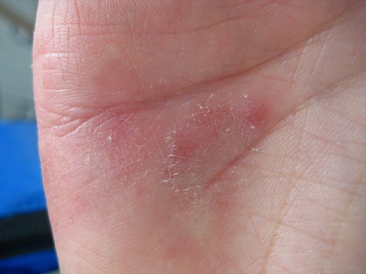 Skin Allergy seen on a person's hand